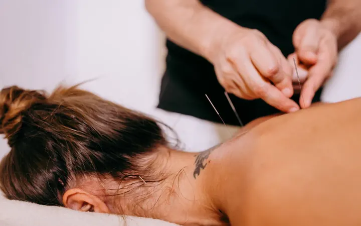 Aplicação de acupuntura na região do pescoço e ombro
