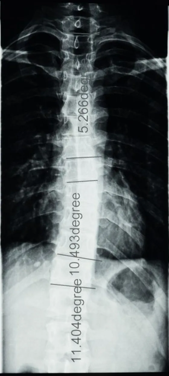 Radiografia da coluna com curvatura escoliótica e medição de ângulos